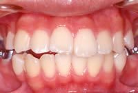 外から見えない矯正