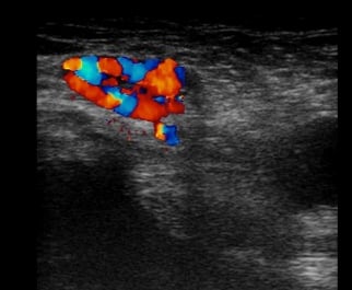 Varikosis des Ligamentum rotundum - hernienzentrum.berlin