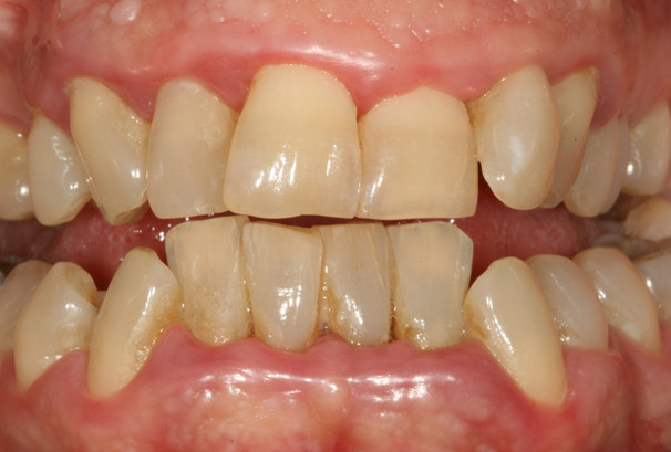 La gencive est rouge et gonflée.