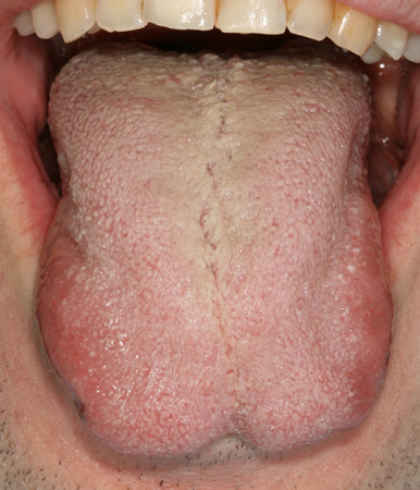 Papilles filiformes longues et dépôt lingual blanchâtre sur la partie postérieure de la langue.