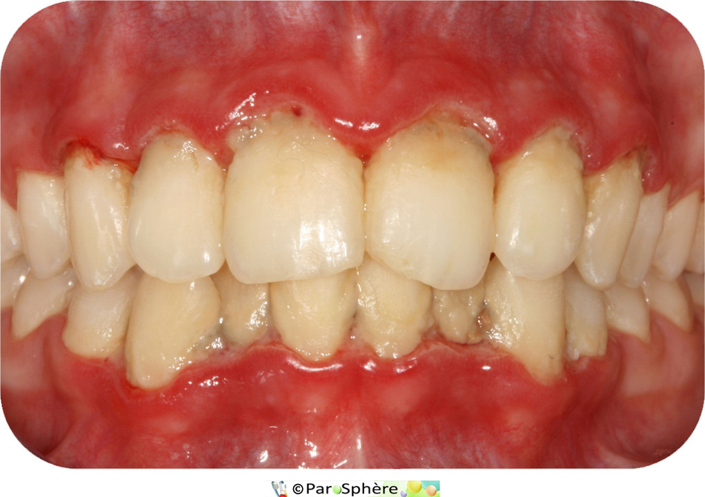 Parodontite ulcéro-nécrotique avant traitement.