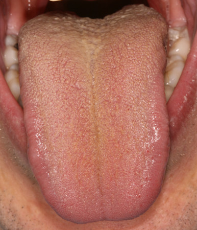 Dépôt lingual blanchâtre sur la partie postérieure de la langue.