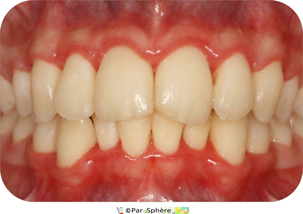 Parodontite ulcéro-nécrotique après traitement.