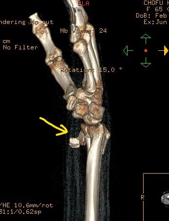 前腕骨下端骨折　橈骨骨折　　国分寺こみね鍼灸整骨院