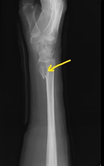 右橈骨骨折　スミス骨折　　国分寺　こみね鍼灸整骨院