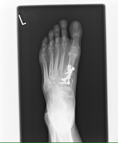 外科手術　ボルトと金具で固定　手術後適切なリハビリがなく浮腫と関節拘縮により歩行困難　国分寺こみね鍼灸整骨院でリハビリ