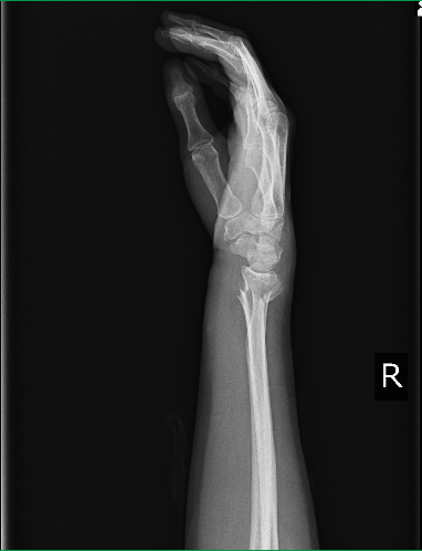 長期固定による浮腫　関節拘縮