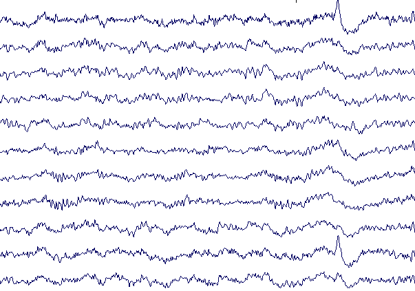 EEG - l'électro-encéphalogramme