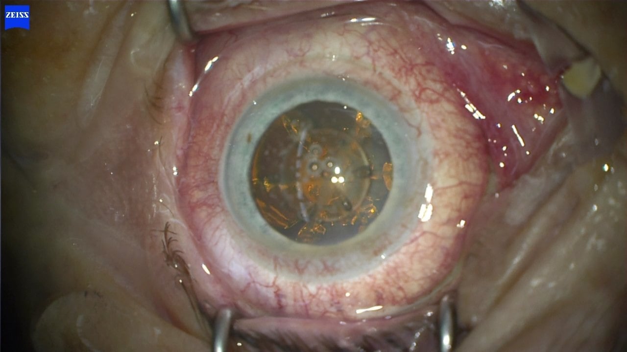 Erscheinungsbild der Linse direkt nach Lasereinsatz. Man erkennt die geschnittenen Anteile der Linse mit bloßem Auge.