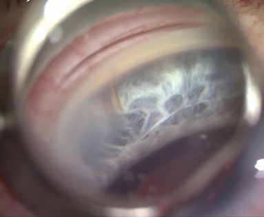 Implantierter XEN Stent bei Sicht mit einem Kontaktglas