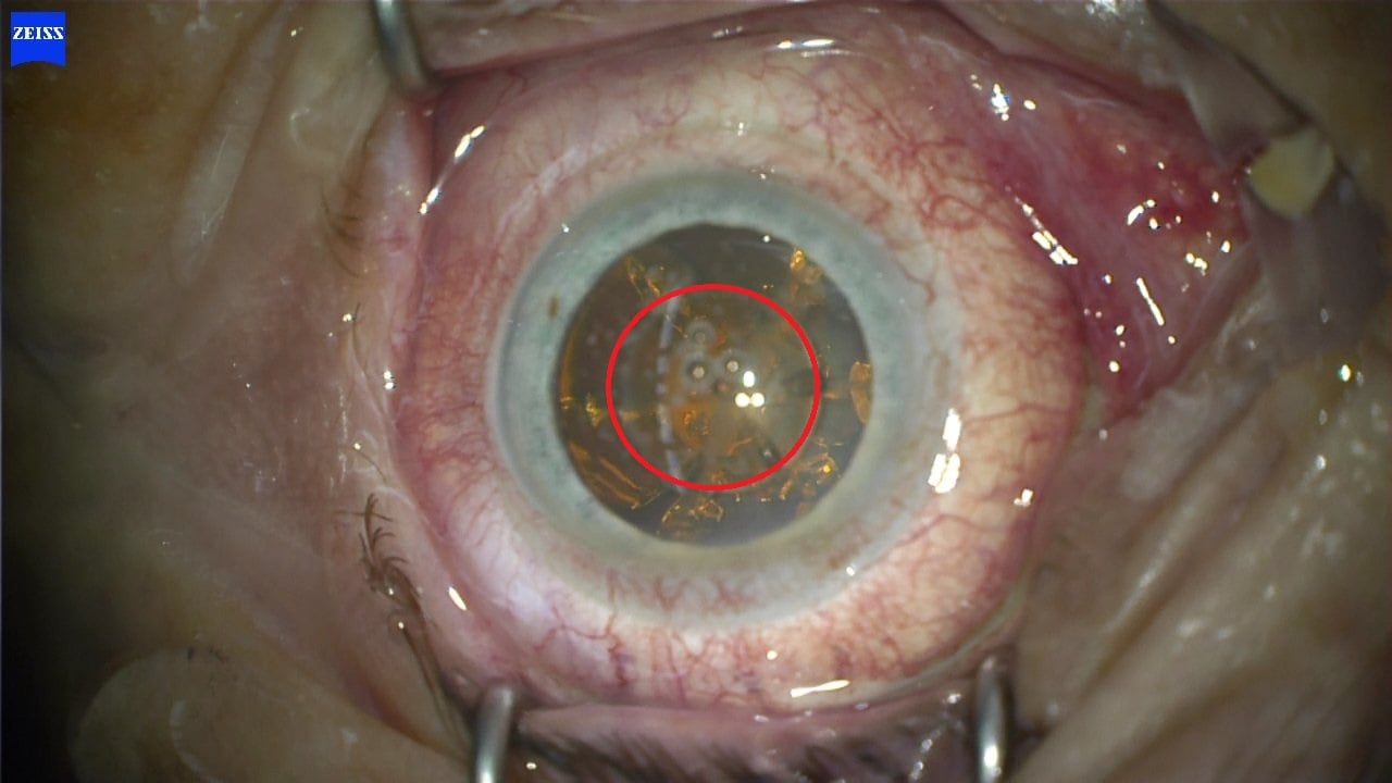 Eingezeichnet die Femto-Laser geschnittene kreisrunde Linseneröffnung mit höchster Präzision