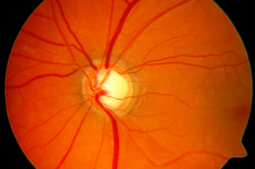 Glaukomtöse Papillenexkavation