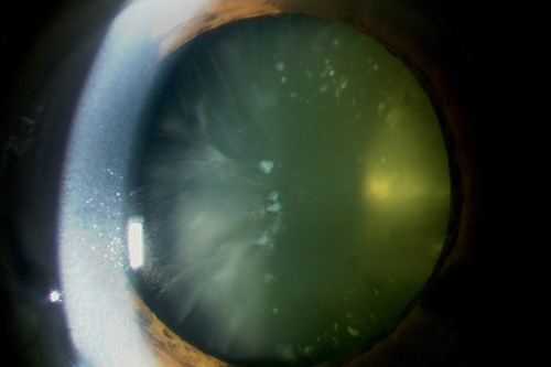 Typische altersbedingte Linsentrübung - die "Kararakt" oder der "graue Star"