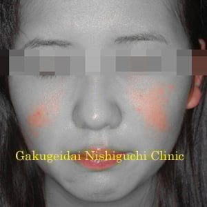 治療開始後2週間目：デジタルフィルタ加工後