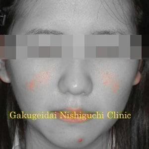 治療開始後4週間目：デジタルフィルタ加工後