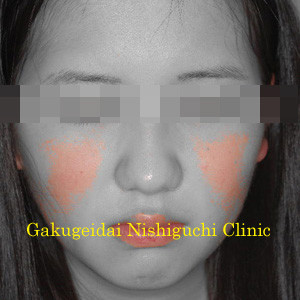 初診時：デジタルフィルタ加工後