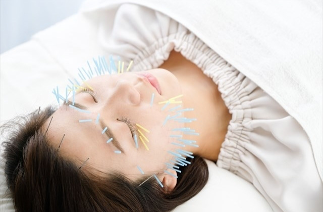 美容鍼イメージ【写真】