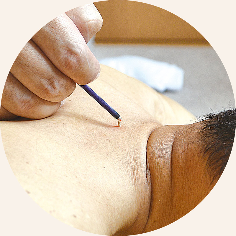 お灸療法｜西山鍼灸院（新潟市中央区本町通）