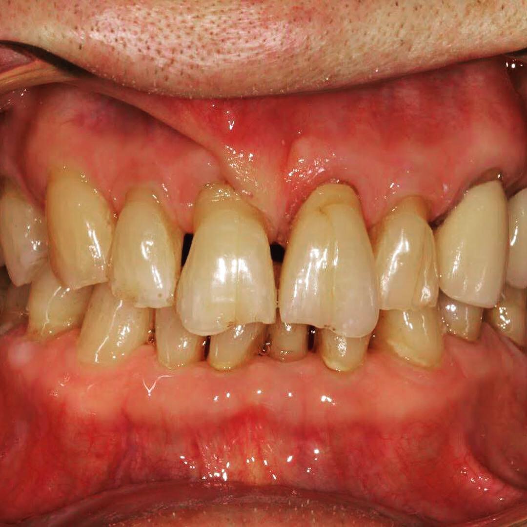 Case-8 Single Central Zr