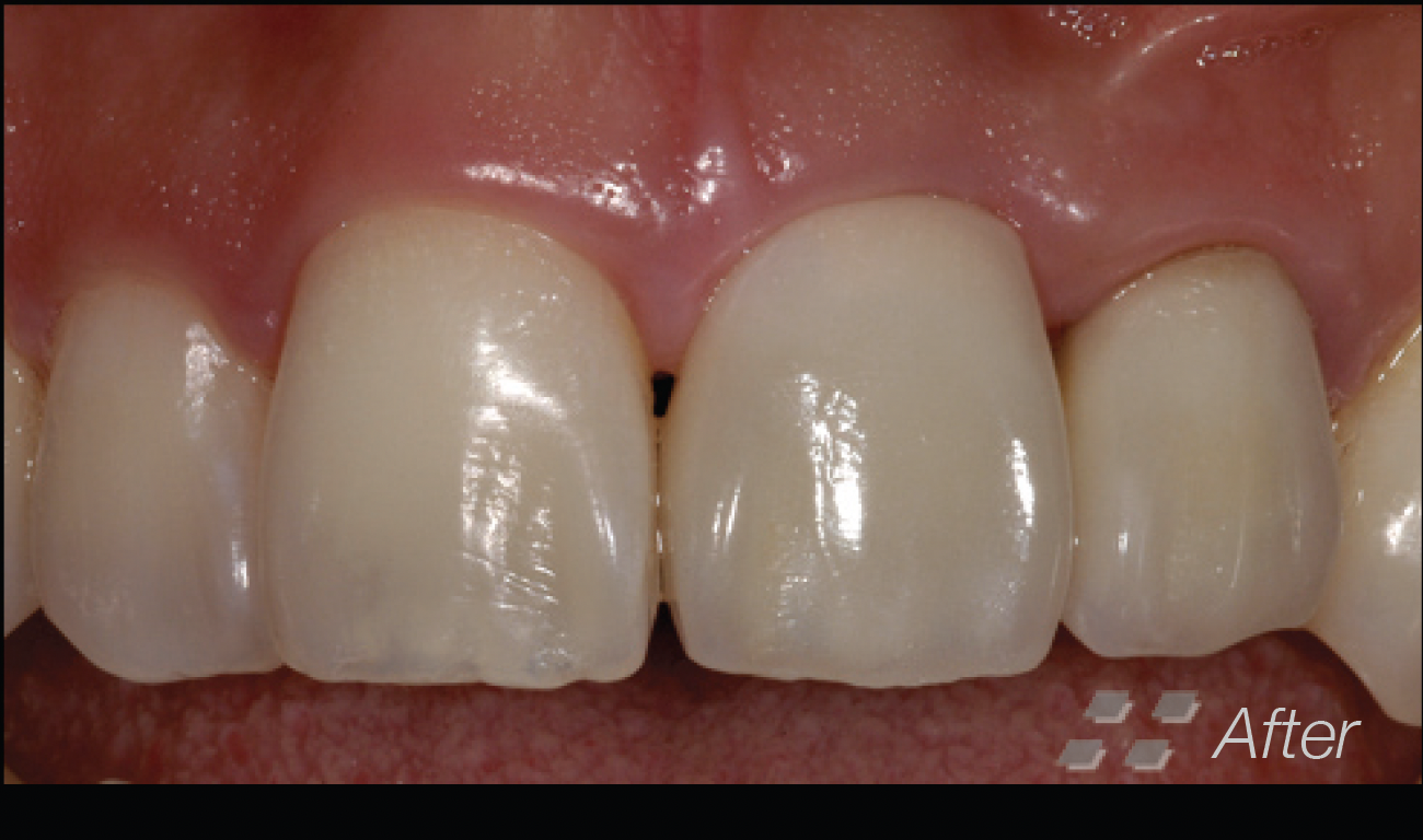 Implant Supported Metal Ceramic Crowns