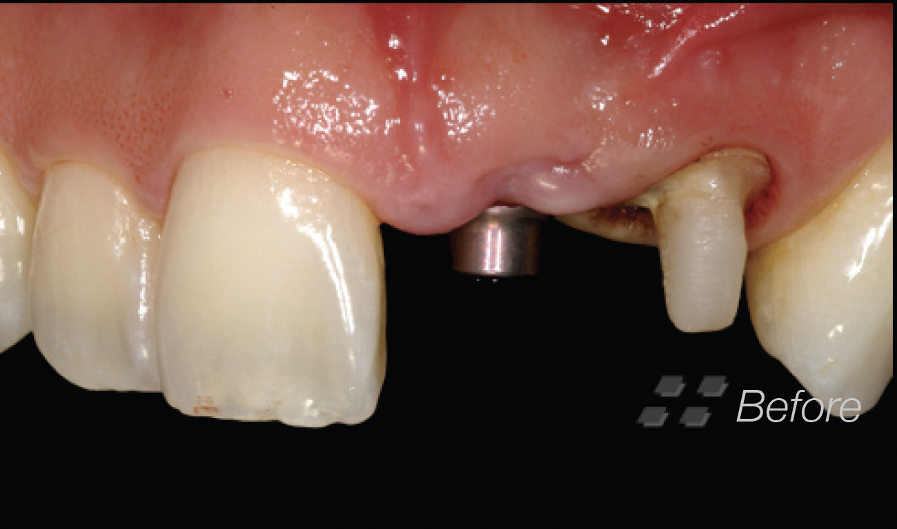 Implant Supported Metal Ceramic Crowns