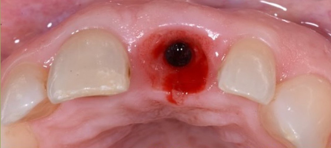 Case-1 Implant Zr Crown