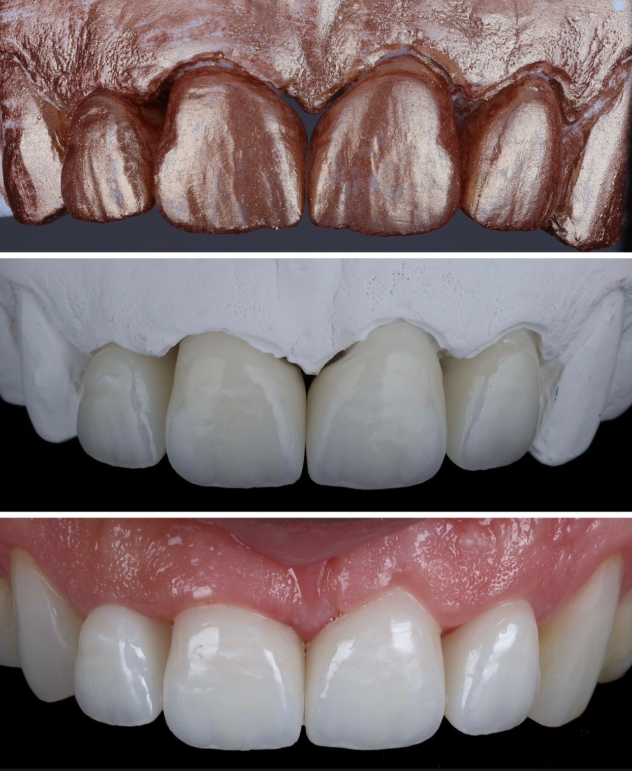 Case-6 Zr Crowns