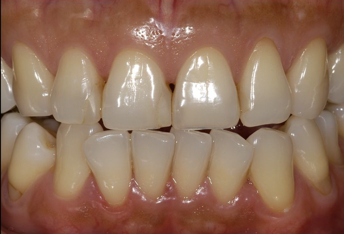 Porcelain Crowns and Veneers