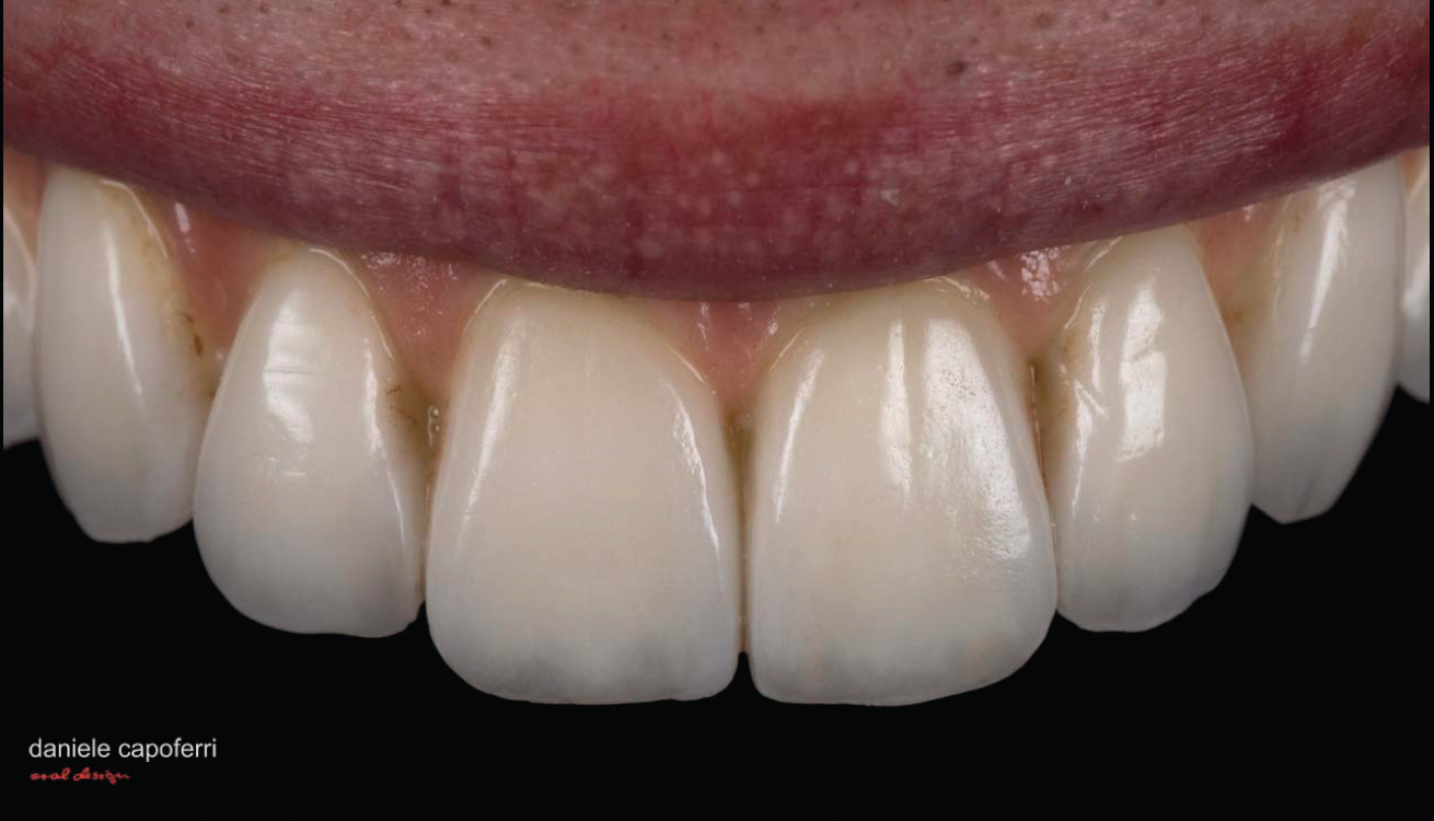 Full Mouth Restoration