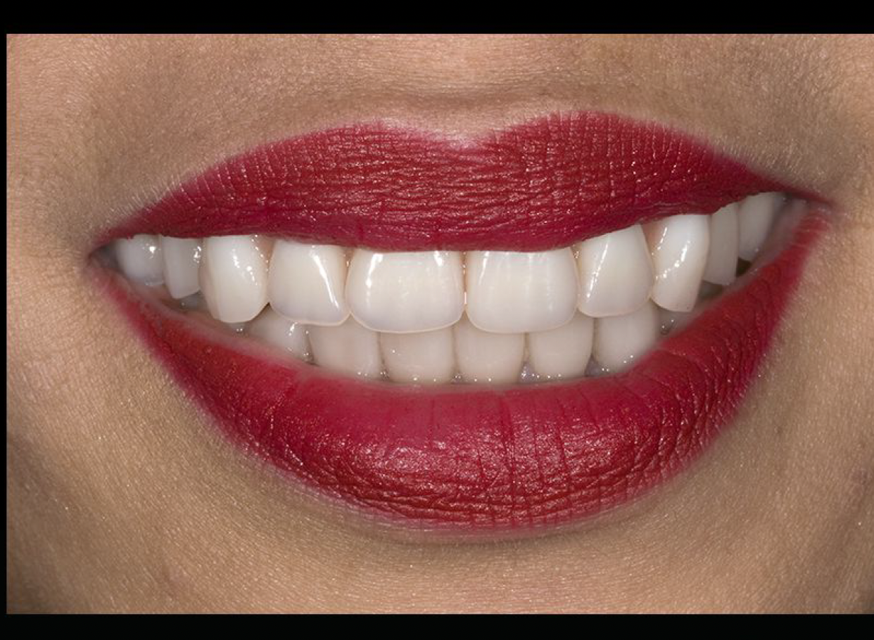 Hybrid Fixed Denture