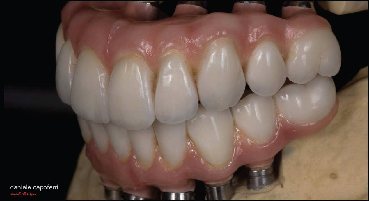 Full Mouth Restoration