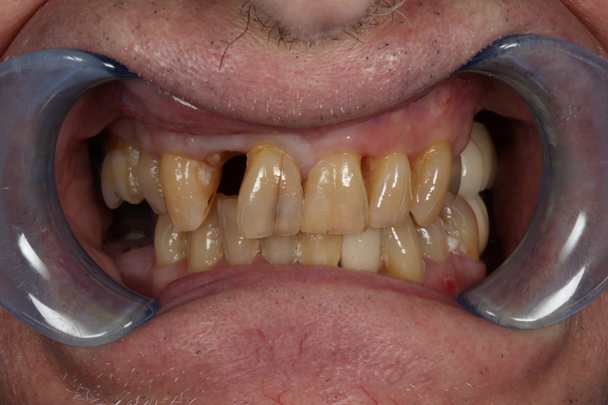 Case-7 Metal Ceramic Maryland