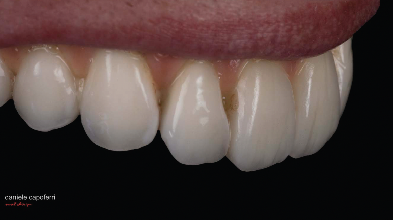 Full Mouth Restoration