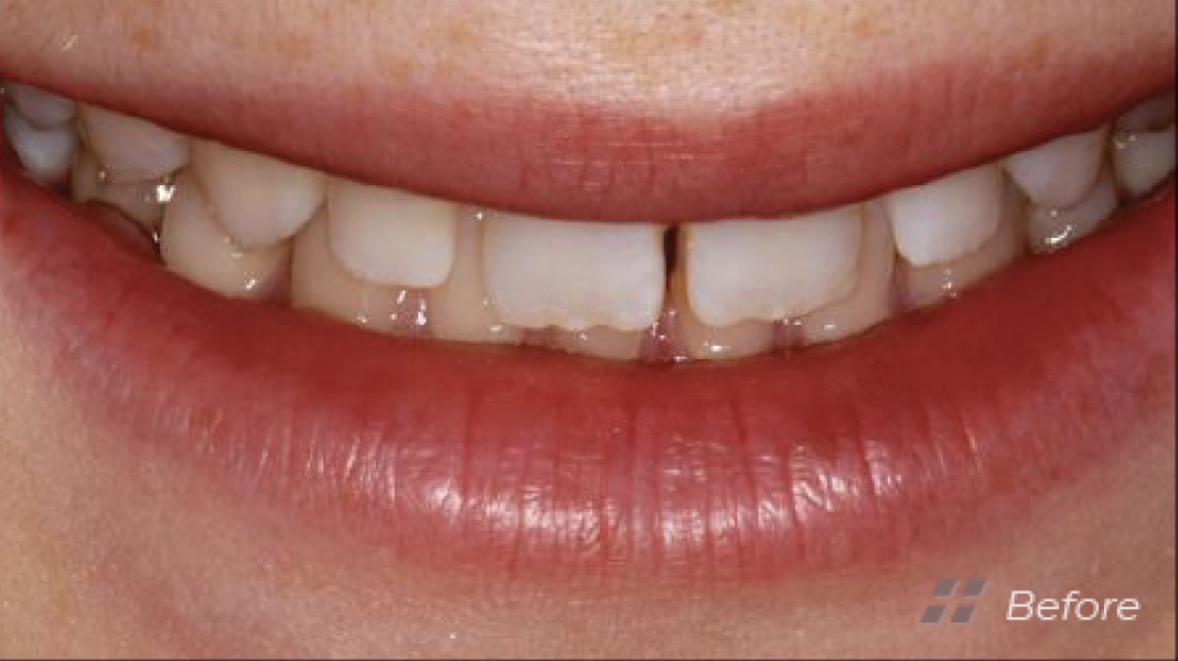 Porcelain Veneers