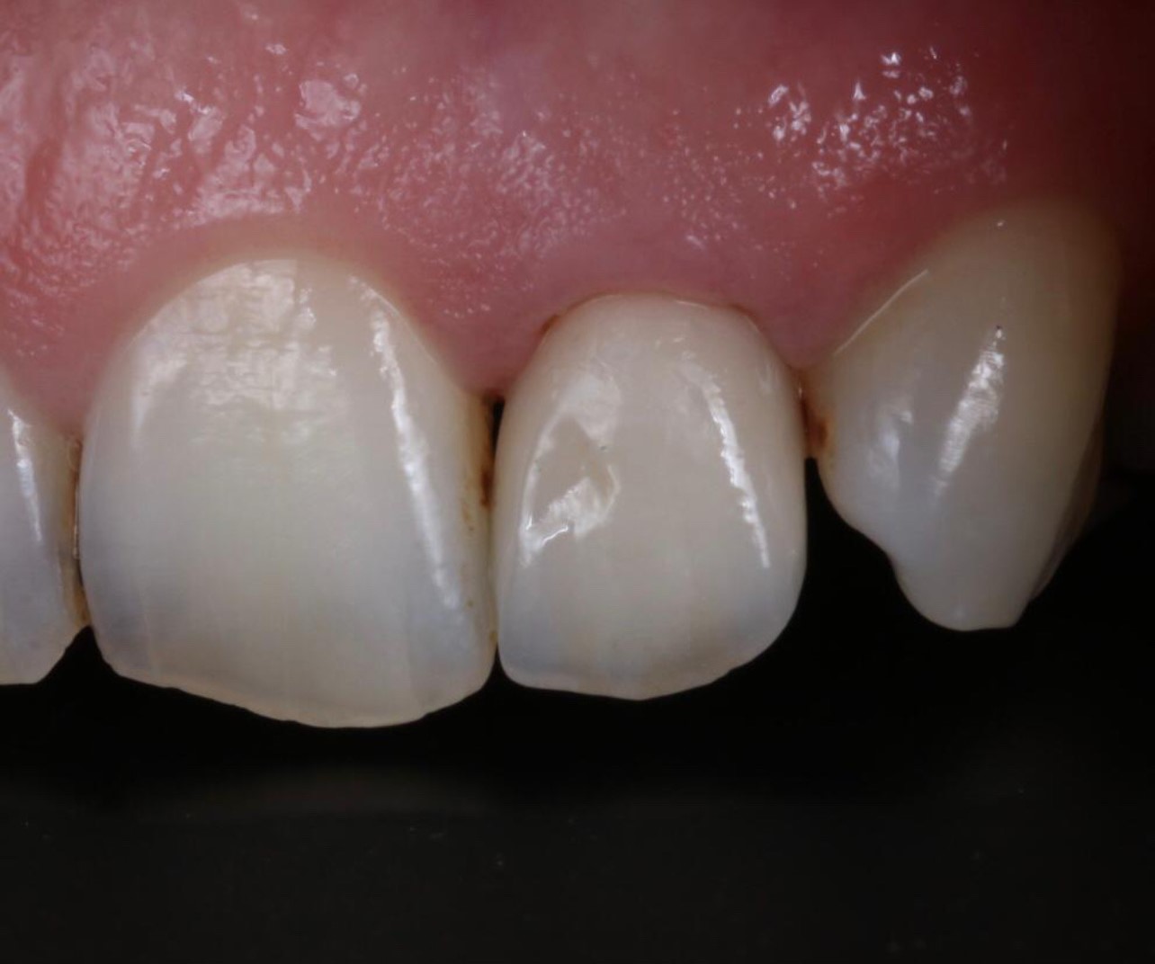 Case-4 e.max veneer