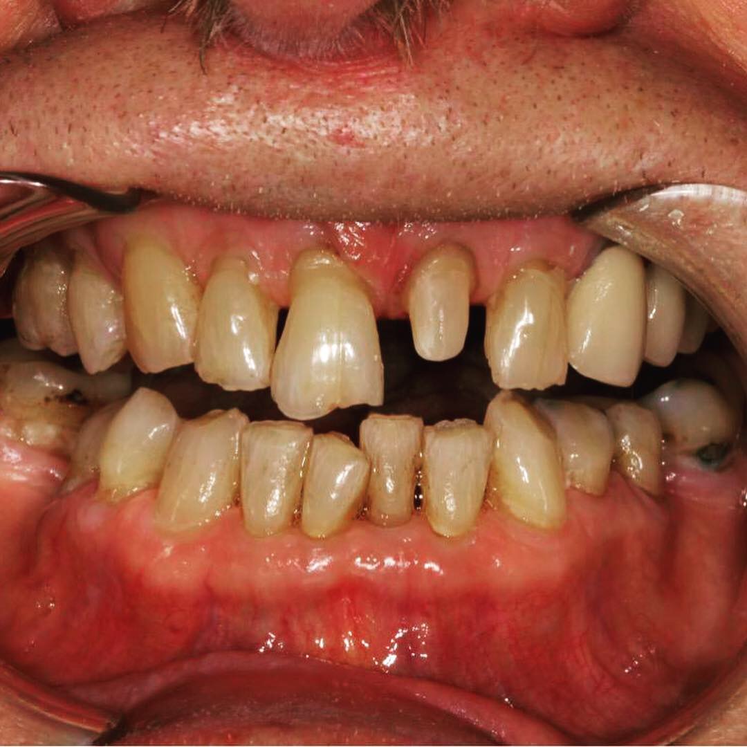 Case-8 Single Central Zr