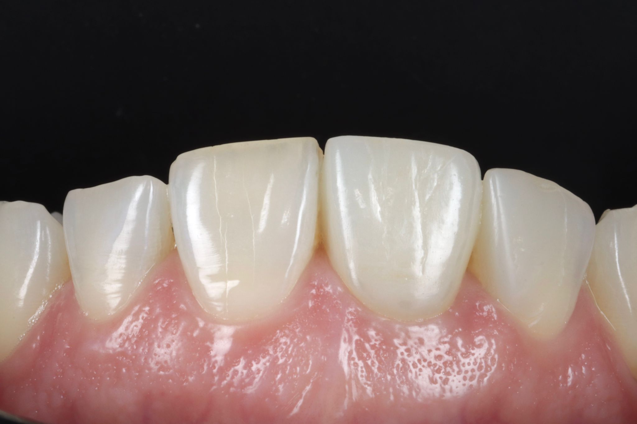 Case-2 Single Central Implant Zr Crown