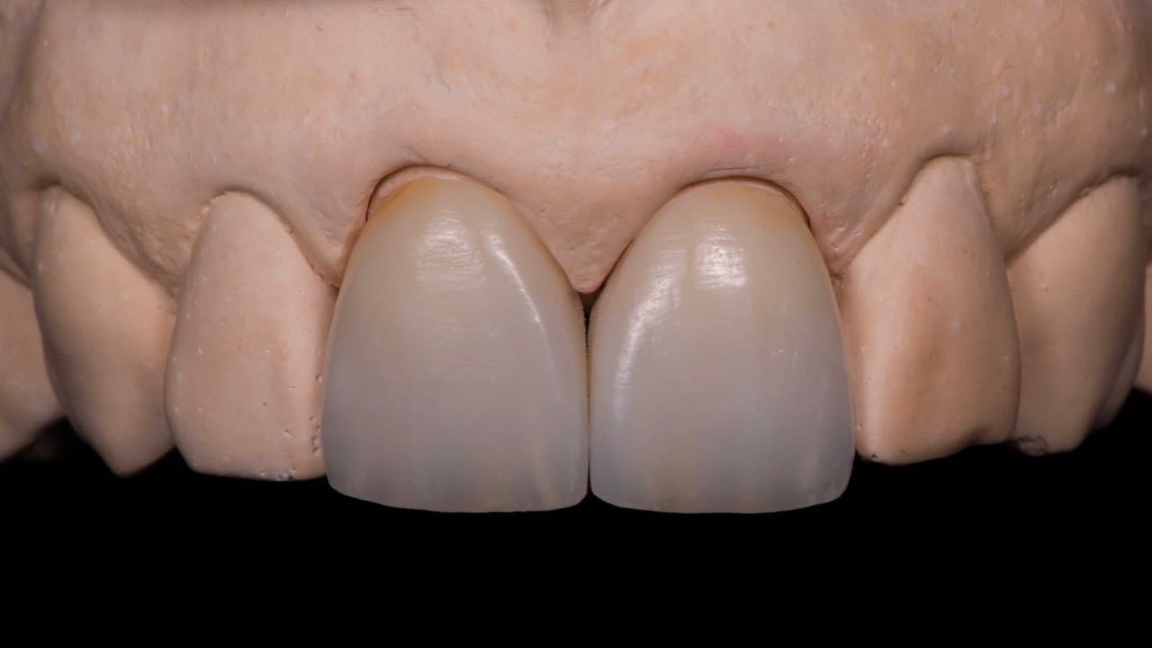 ZI-CT zirconia crown made by Hands-on