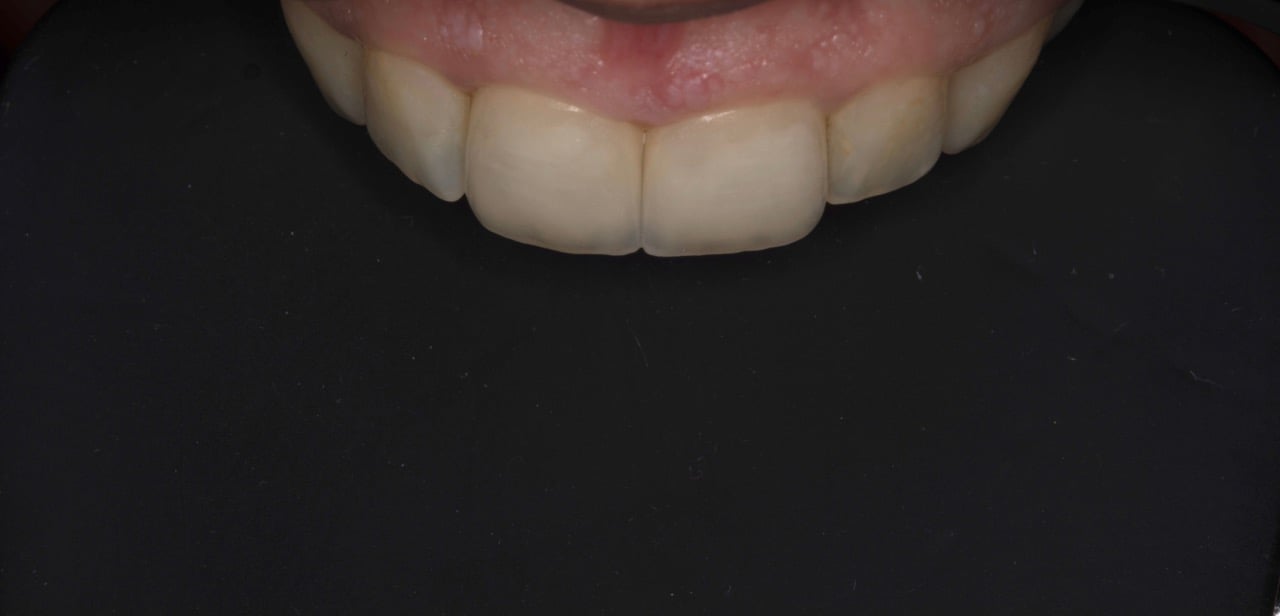 Case-1  After(2Veneers0
