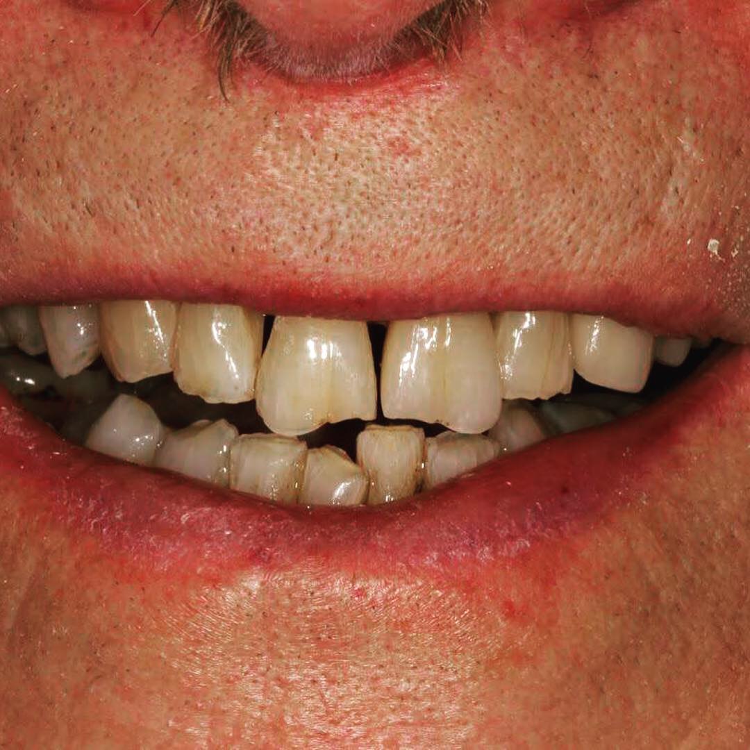 Case-8 Single Central Zr