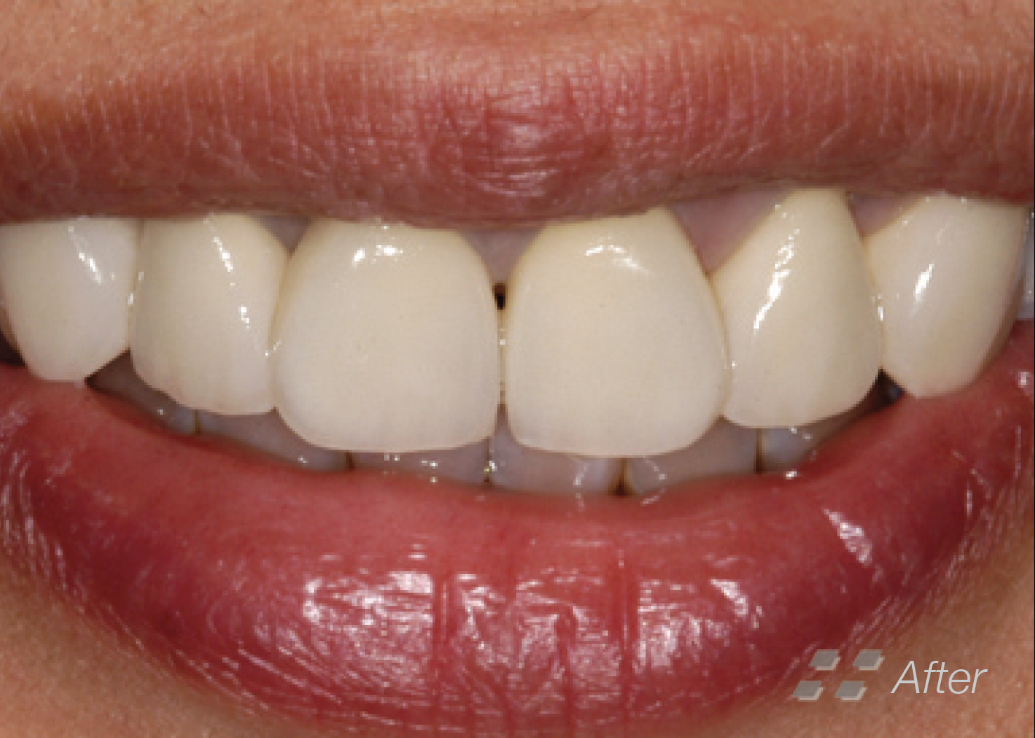Metal Ceramic Crowns