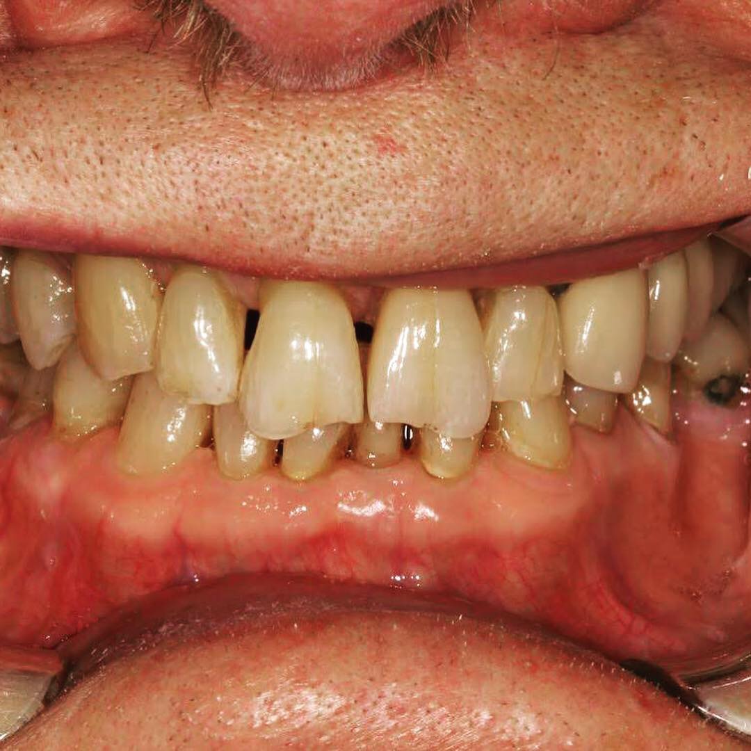 Case-8 Single Central Zr