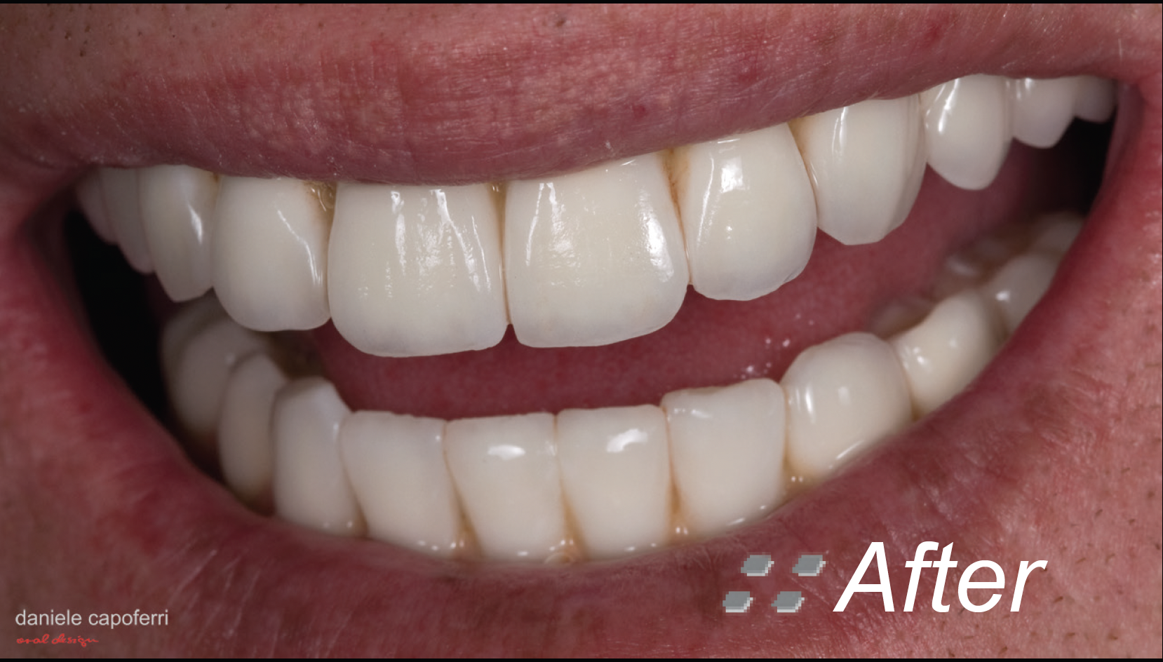 Full Mouth Restoration