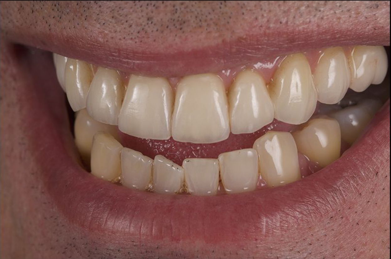 Implant Supported Fixed Bridges