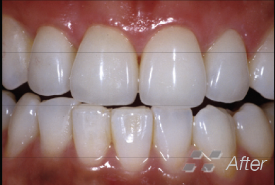 Porcelain Crowns & Esthetic Crown Lenghthening