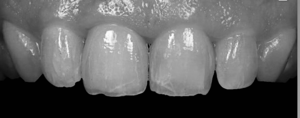 Case-1 Implant Zr Crown