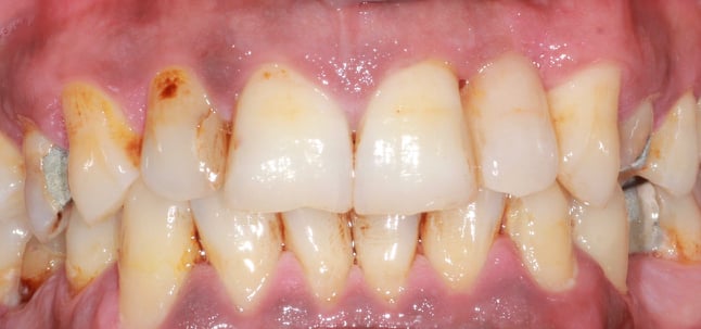 Case-3 After (Maryland)