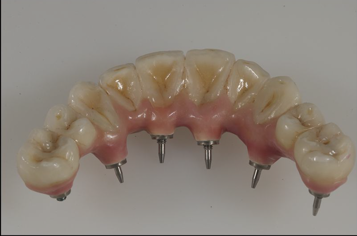 Implant Supported Fixed Bridges