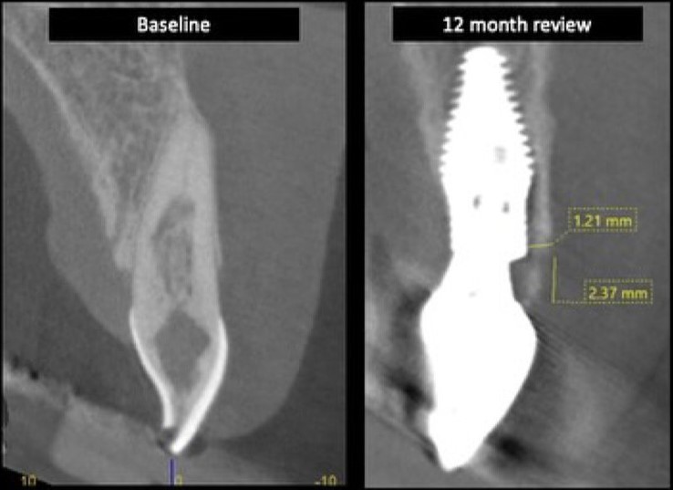 Case-1 Implant Zr Crown