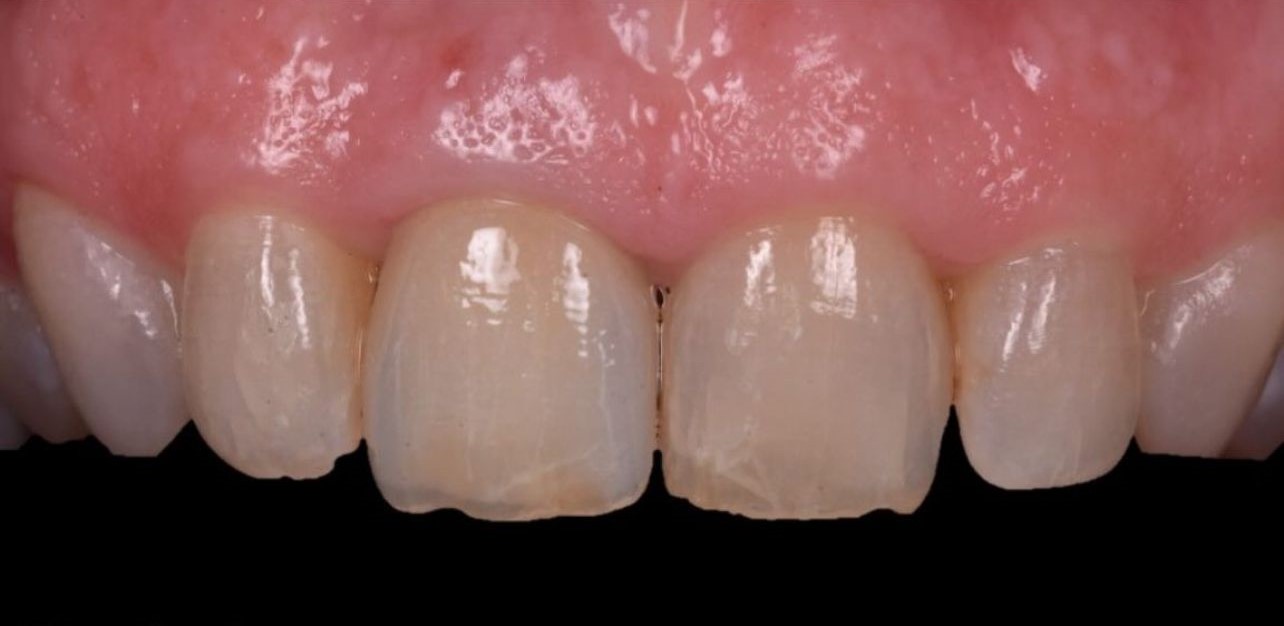 Case-1 Implant Zr Crown